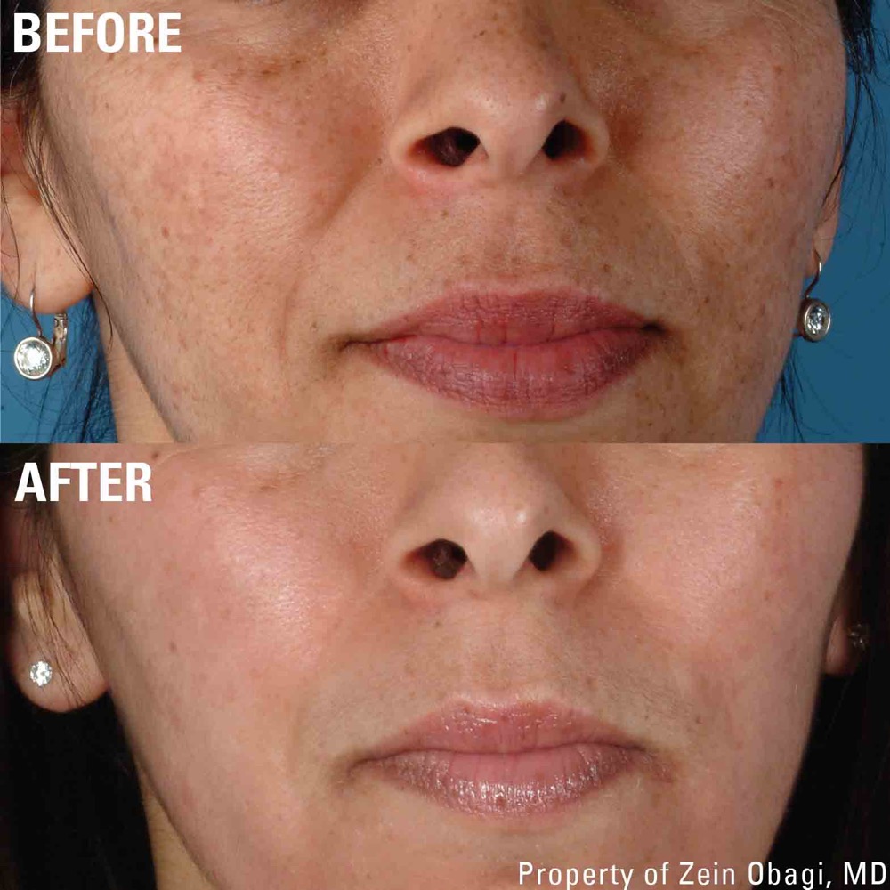 ZO Skin Care - Sun Damage