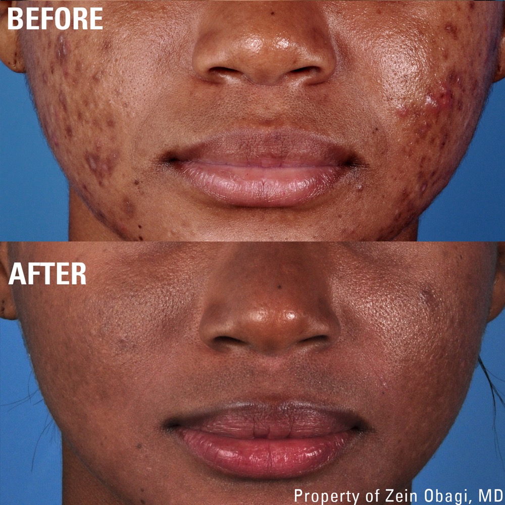 ZO Skin Care - Trasf Acne